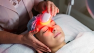 Luce Pulsata Intensa (LPI) per la Rosacea Sollievo e Controllo di una Condizione Impegnativa