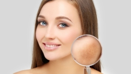 Acido Tranexamico in Cosmetica Trattare l'Iperpigmentazione