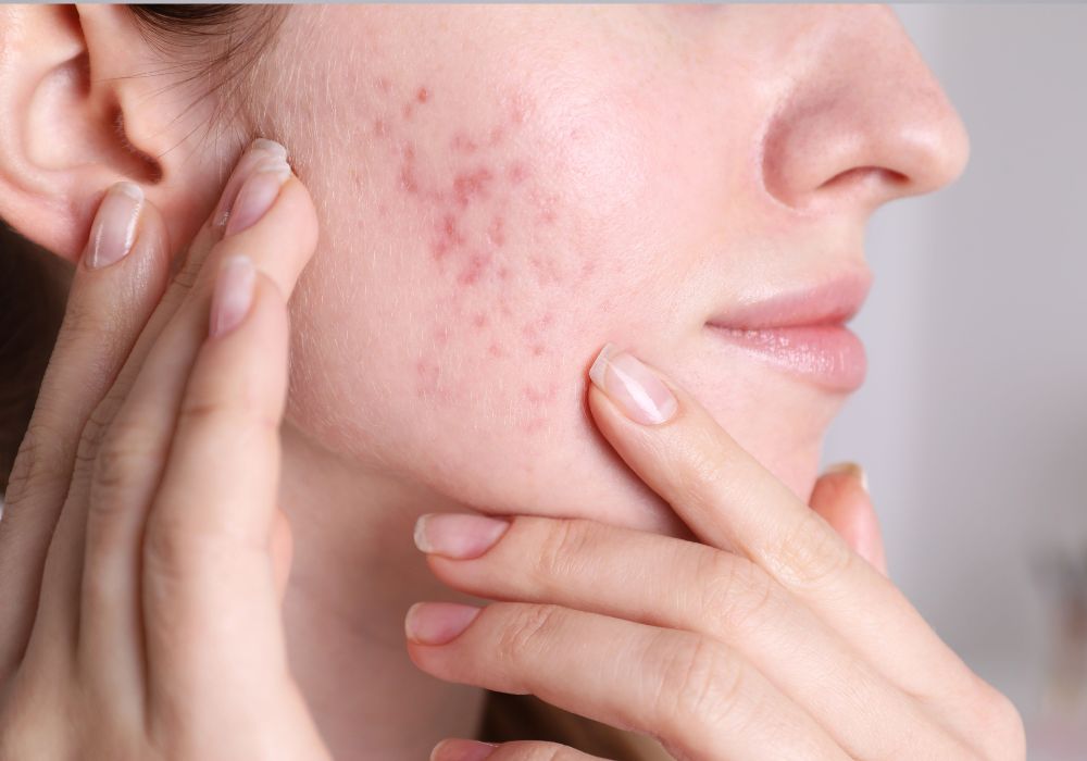 Cuidados diários para controlar a rosácea