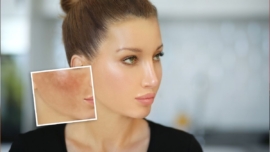 Diferença entre Melasma e Hiperpigmentação Qual Dermocosmético Usar