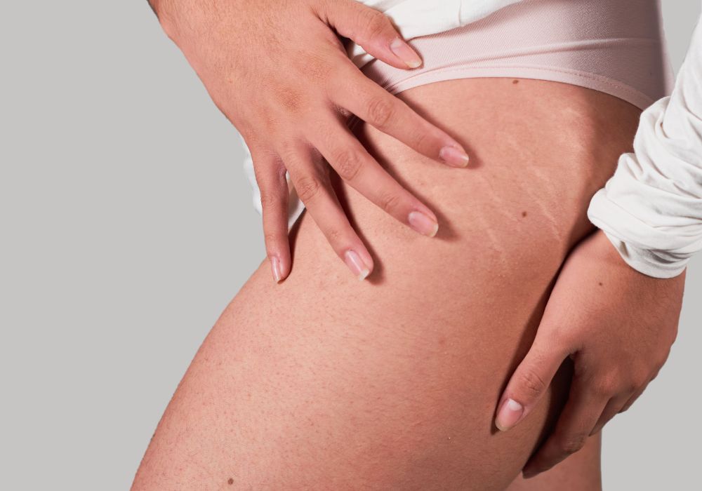 Existe cura definitiva para estrias