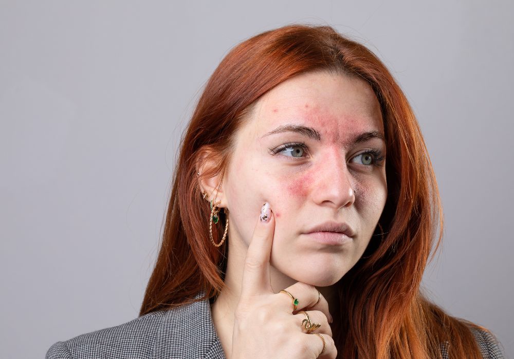 O que é Rosácea O que evita e quais produtos realmente ajudam