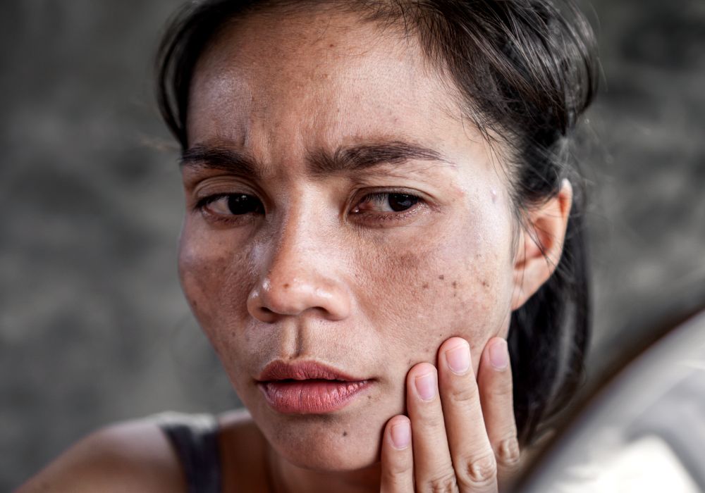 Os Melhores Dermocosméticos para Tratar o Melasma