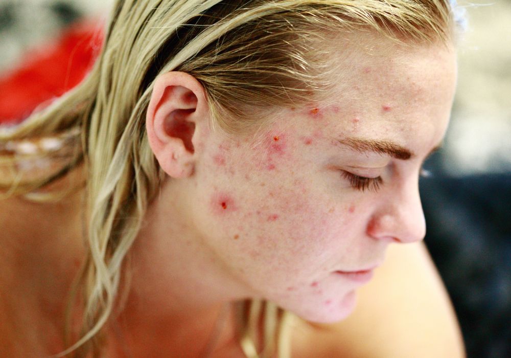 Outros dermocosméticos eficazes para acne e seus preços