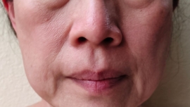 Qual o Melhor Dermocosmético para Flacidez Facial