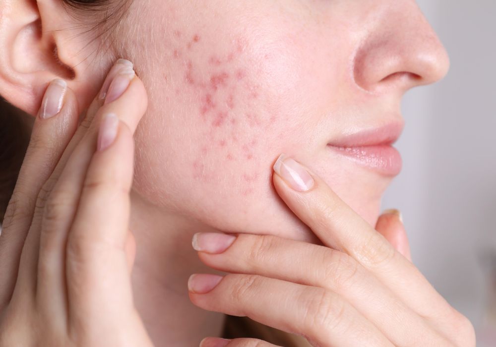 Qual o Melhor Dermocosmético para Tratar Acne e Quanto Custa em Média