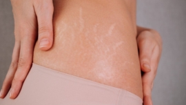 Qual o Melhor Dermocosmético para Tratar Estrias