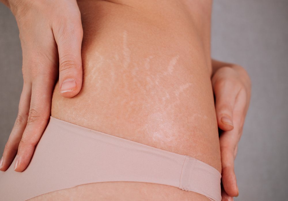 Qual o Melhor Dermocosmético para Tratar Estrias