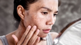 Qual o Melhor Dermocosmético para Tratar Melasma