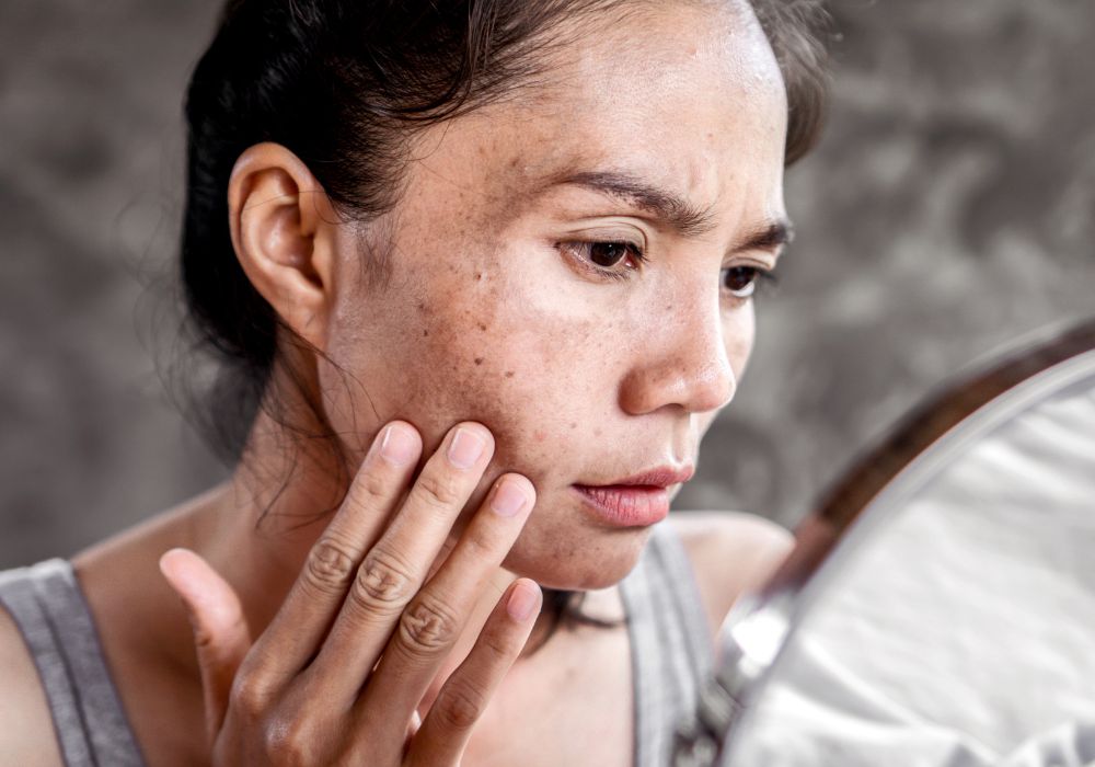 Qual o Melhor Dermocosmético para Tratar Melasma