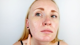 Rotina de Skincare para Quem Tem Pele Oleosa - Pele Saudável e Equilibrada