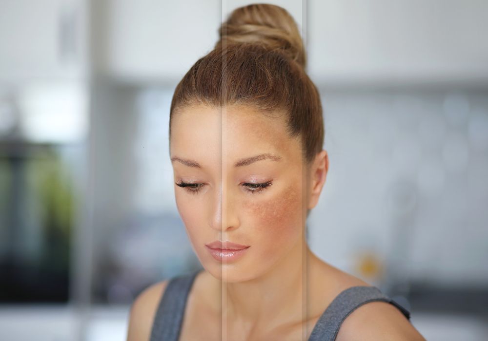 Clareador de Melasma é Seguro para Peles Sensíveis