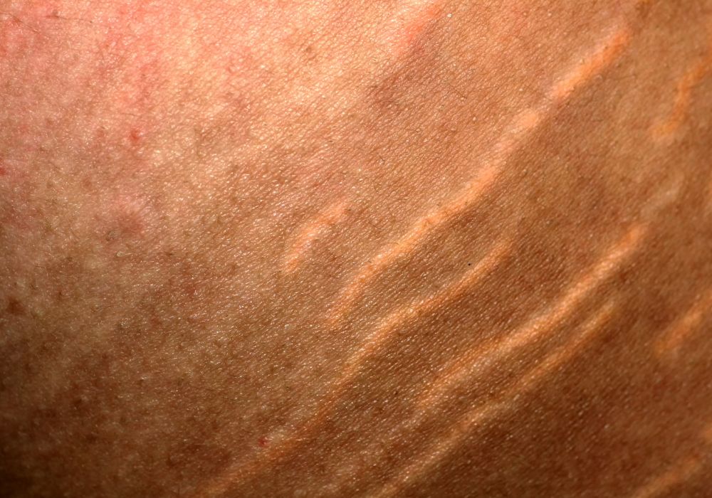 Melhor Tratamento Estético Para Estrias Vermelhas Recentes